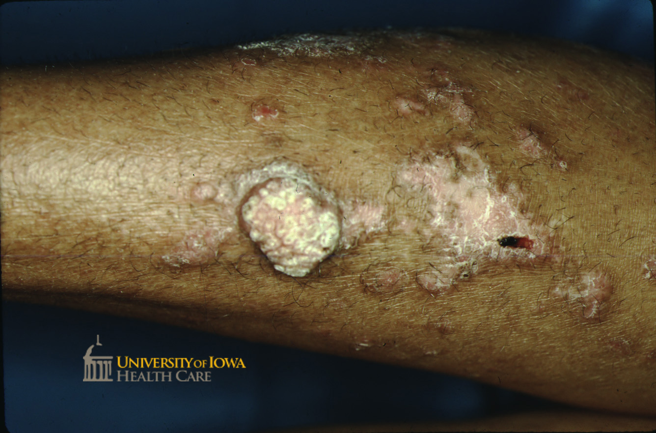 Pink cobblestones plaque with surrounding pink to violaceous coalescing papules. (click images for higher resolution).